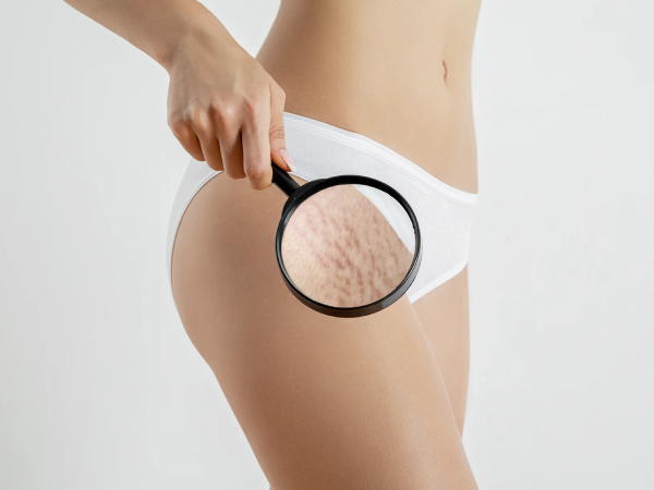 Qu'est-ce que LineLase™ ?